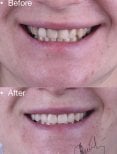 Before and after veneers result at Dentaland Premium Luxury Clinic & Academy, smile makeover