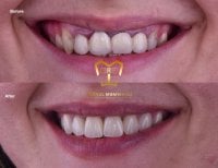 Before and after veneers result at Dentaland Premium Luxury Clinic & Academy, smile makeover