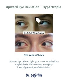 Strabismus surgery before and after results at DrCagatay Eye Clinic, improved eye alignment