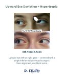 Strabismus surgery before and after results at DrCagatay Eye Clinic, improved eye alignment