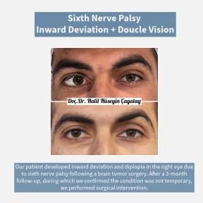 Before and after strabismus surgery result for sixth nerve palsy at DrCagatay Eye Clinic