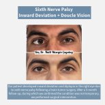 Before and after strabismus surgery result for sixth nerve palsy at DrCagatay Eye Clinic