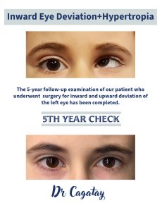 Strabismus surgery before and after results at DrCagatay Eye Clinic, 5-year follow-up