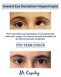 Strabismus surgery before and after results at DrCagatay Eye Clinic, 5-year follow-up