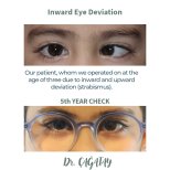 Before and after strabismus surgery result at DrCagatay Eye Clinic, 5-year follow-up