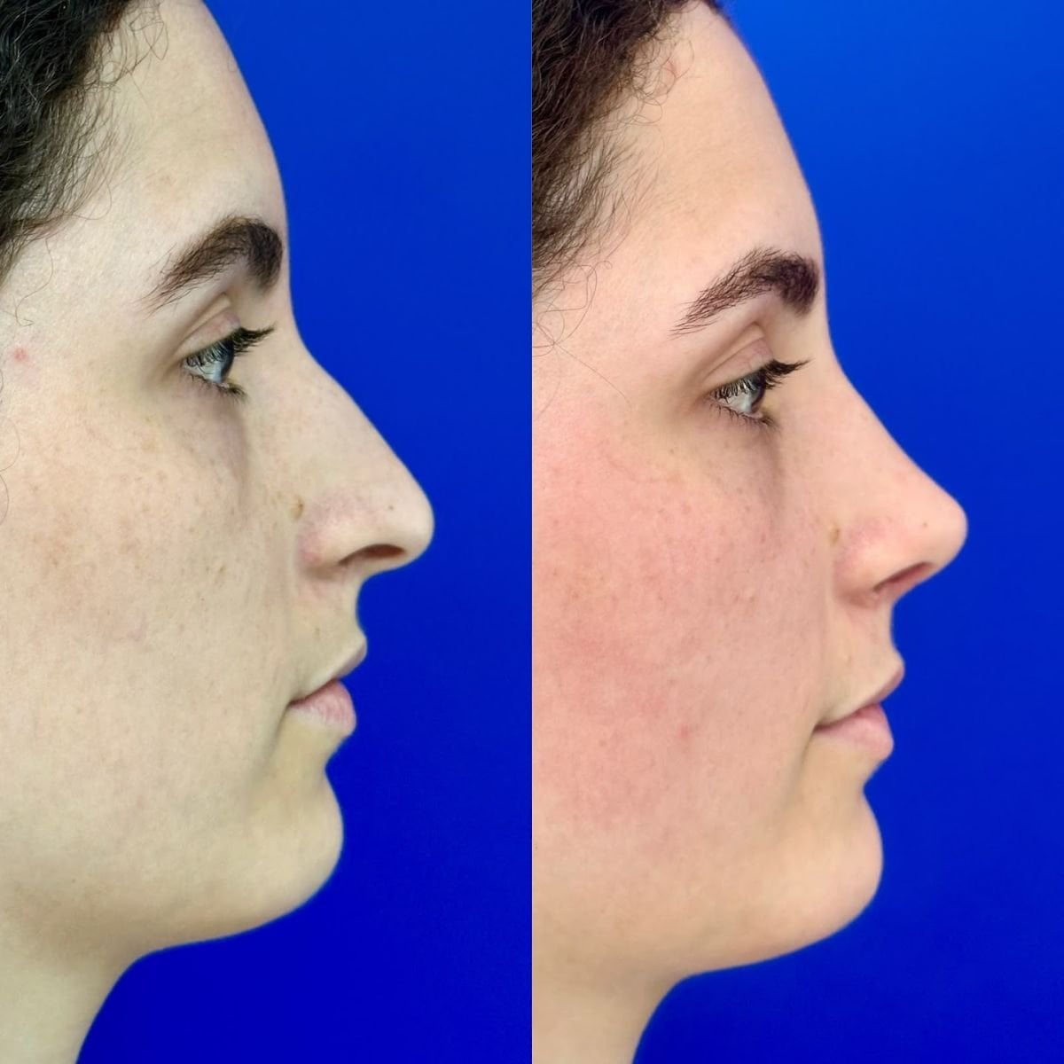 نتائج عملية تجميل الأنف قبل وبعد في مستشفى إنترارات، تحسين شكل الأنف