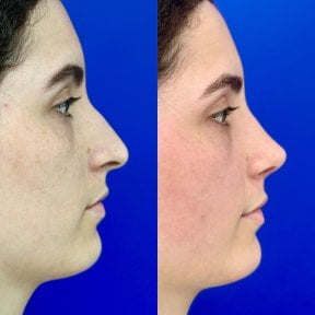 before-after photo rhinoplasty-nose-job