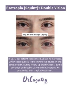 Before and after strabismus surgery results at DrCagatay Eye Clinic for esotropia correction