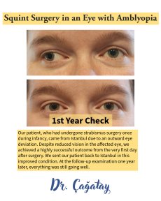 Strabismus surgery before and after results at DrCagatay Eye Clinic, improved eye alignment