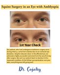 Strabismus surgery before and after results at DrCagatay Eye Clinic, improved eye alignment