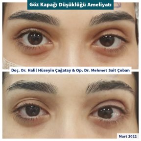 Before and after ptosis surgery results at DrCagatay Eye Clinic, improved eyelid appearance