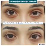 Before and after ptosis surgery results at DrCagatay Eye Clinic, improved eyelid appearance