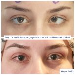 Before and after strabismus surgery results at DrCagatay Eye Clinic, improved eye alignment