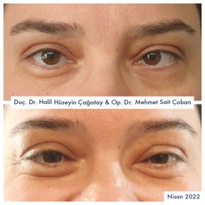 Before and after strabismus surgery results at DrCagatay Eye Clinic, improved eye alignment