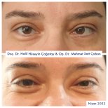 Before and after strabismus surgery results at DrCagatay Eye Clinic, improved eye alignment