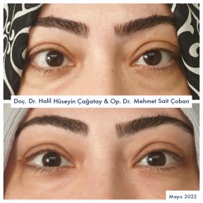 Before and after strabismus surgery results at DrCagatay Eye Clinic, improved eye alignment