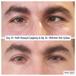 Before and after strabismus surgery result at DrCagatay Eye Clinic, improved eye alignment