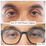 Before and after strabismus surgery results at DrCagatay Eye Clinic, improved eye alignment