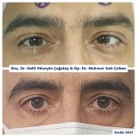 Before and after strabismus surgery results at DrCagatay Eye Clinic, improved eye alignment