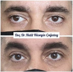 Before and after strabismus surgery result at DrCagatay Eye Clinic, eye alignment improved