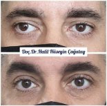 Before and after strabismus surgery result at DrCagatay Eye Clinic, eye alignment improved