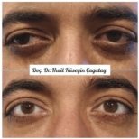 Before and after strabismus surgery result at DrCagatay Eye Clinic, improved eye alignment