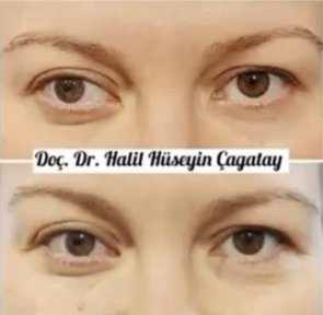 Before and after strabismus surgery results at DrCagatay Eye Clinic, improved eye alignment
