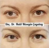 Before and after strabismus surgery results at DrCagatay Eye Clinic, improved eye alignment