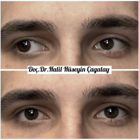 Before and after strabismus surgery results at DrCagatay Eye Clinic, improved eye alignment