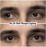 Before and after strabismus surgery results at DrCagatay Eye Clinic, improved eye alignment