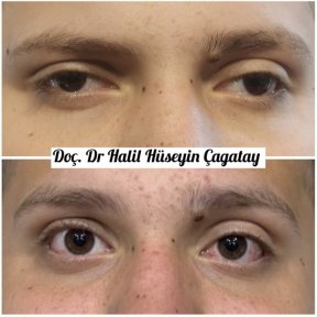 Before and after strabismus surgery result at DrCagatay Eye Clinic, improved eye alignment