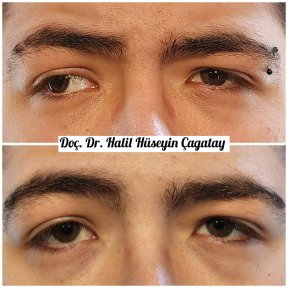 Before and after strabismus surgery result at DrCagatay Eye Clinic, improved eye alignment