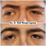 Before and after strabismus surgery result at DrCagatay Eye Clinic, improved eye alignment