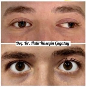 Before and after strabismus surgery results at DrCagatay Eye Clinic, improved eye alignment