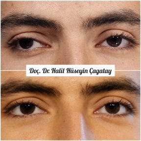 Before and after strabismus surgery results at DrCagatay Eye Clinic, improved eye alignment