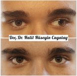 Before and after strabismus surgery results at DrCagatay Eye Clinic, improved eye alignment