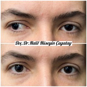 Before and after strabismus surgery results at DrCagatay Eye Clinic, improved eye alignment