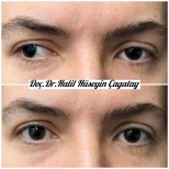 Before and after strabismus surgery results at DrCagatay Eye Clinic, improved eye alignment