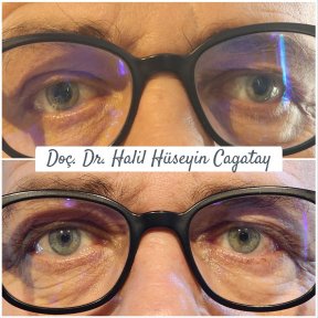 Before and after strabismus surgery results at DrCagatay Eye Clinic, improved eye alignment