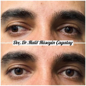 Before and after strabismus surgery results at DrCagatay Eye Clinic, improved eye alignment