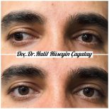 Before and after strabismus surgery results at DrCagatay Eye Clinic, improved eye alignment