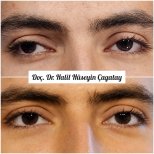 Before and after strabismus surgery results at DrCagatay Eye Clinic, improved eye alignment