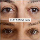 Before and after strabismus surgery results at DrCagatay Eye Clinic, eye alignment improved