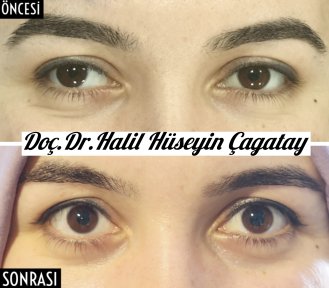 Before and after strabismus surgery result at DrCagatay Eye Clinic, improved eye alignment