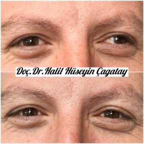 Before and after strabismus surgery results at DrCagatay Eye Clinic, improved eye alignment