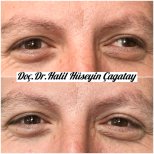 Before and after strabismus surgery results at DrCagatay Eye Clinic, improved eye alignment
