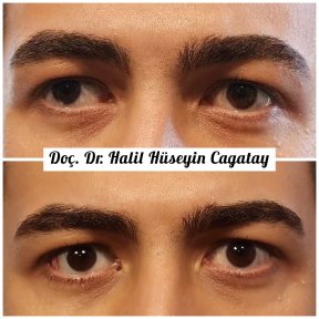 Before and after strabismus surgery result at DrCagatay Eye Clinic, improved eye alignment