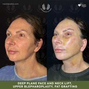 before-after photo deep-plane-facelift