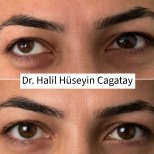 Before and after strabismus surgery results at DrCagatay Eye Clinic, improved eye alignment