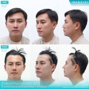 before-after photo rhinoplasty-nose-job